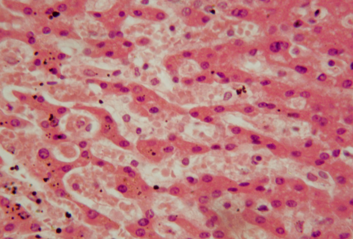 tuberkuloos, abstraktne kujutis